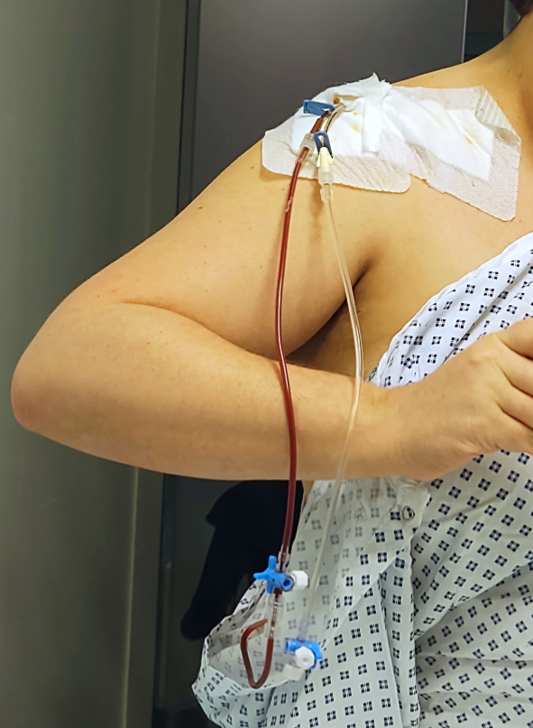 Photo d'un reflux
