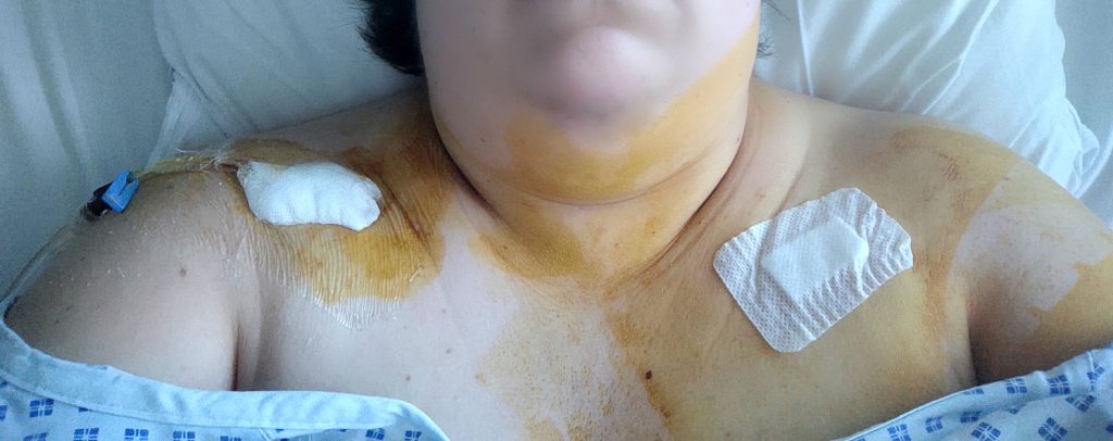 Photo de moi pleine de bétadine